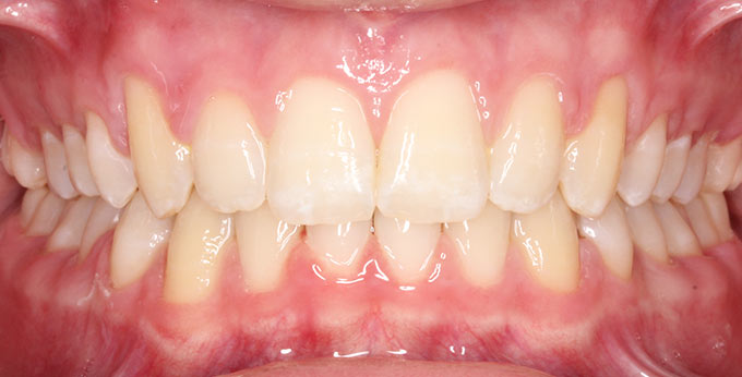 After treatment which involved twin block appliance followed by full fixed appliances (braces)